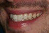 Dental Implants in Costa Mesa